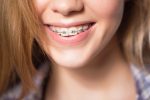 How to Relieve Soreness from Dental Braces