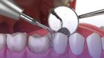 Is Teeth Cleaning Necessary If You Brush Daily?