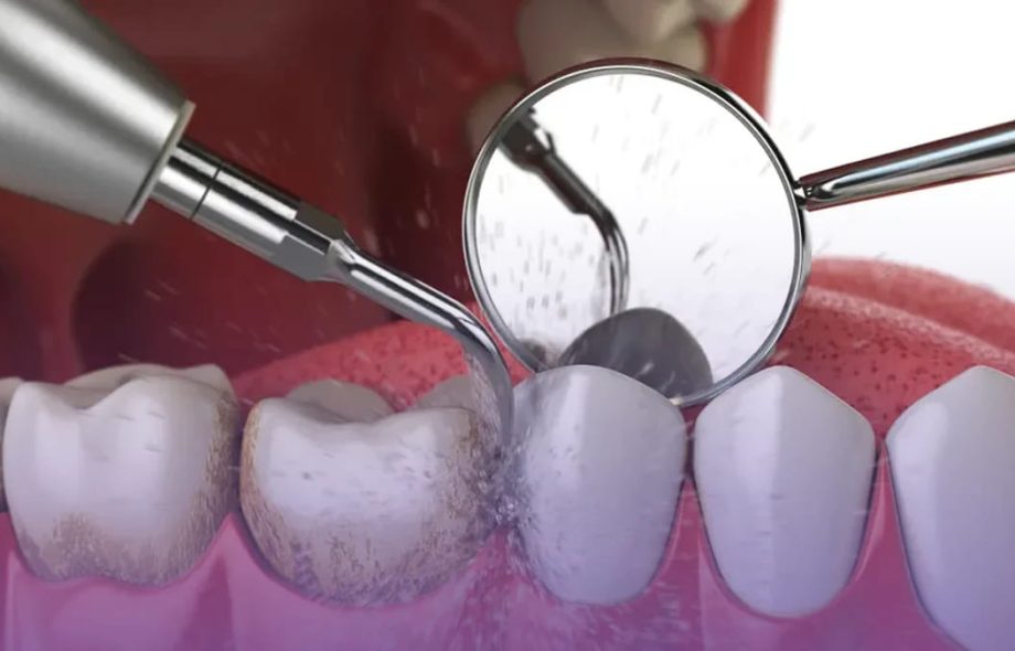 Is Teeth Cleaning Necessary If You Brush Daily?