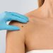 Skin Tag Removal in Dubai